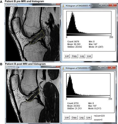 Figure 5 MRIs and histograms for Patient B, (A) pre- and (B) posttreatment.