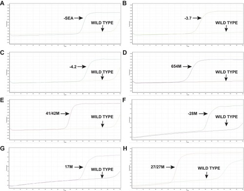 Figure 1 LAMP assays for the positive and negative samples of thalassemia. (A–H) PCR reactions were performed using positive samples and negative samples of thalassemia as templates under these same real-time LAMP reaction conditions.