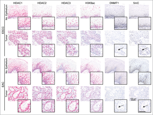 Figure 1. HDACs are deregulated in esophageal cancer cells. The panels show representative serial sections, respective the same tissue areas, of matching normal esophageal epithelium and ESCC or EAC tissue specimens stained for the epigenetic modifiers HDAC1, HDAC2, HDAC3, H3K9ac (red staining; via AP/Streptavidin, DAKO Real Detection system AP/RED) as well as DNMT1 and 5mC (brown staining, via DAB, DAKO envision FLEX+ Kit). Note reduced H3K9ac as well as loss of DNMT1 expression and 5mC (see arrows) in tumor cells of ESCCs and EACs as compared to normal epithelial cells (see inserts). Refer to Supplementary Data Table S1 for quantification of all cases. Bar represents 100 μm.