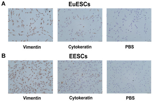 Figure 1 Immunocytochemical staining for vimentin and cytokeratin expression. (A) The cytoplasm of EuESCs was immunopositive for vimentin and immunonegative for cytokeratin. The nuclei were stained with hematoxylin (Magnification ×100). (B) The cytoplasm of EESCs was immunopositive for vimentin and immunonegative for cytokeratin. The nuclei were stained with hematoxylin (Magnification ×100).
