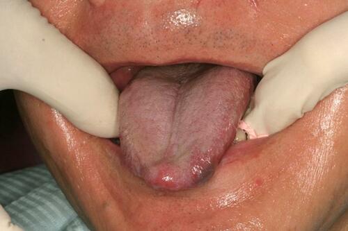 Figure 9 Tongue protruded during impression taking.