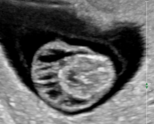 Figure 1 First-trimester septated cystic hygroma in a 36 year-old, P0 at 9 and 4/7 weeks’ gestation. Note the clear well-depicted fluid-filled sacculations. In addition, overall nonimmune fetal hydrops was also noted. Noninvasive prenatal (cfDNA) screening depicted fetal 45, X (Monosomy X, Turner’s syndrome). At her request, the patient underwent termination of pregnancy.