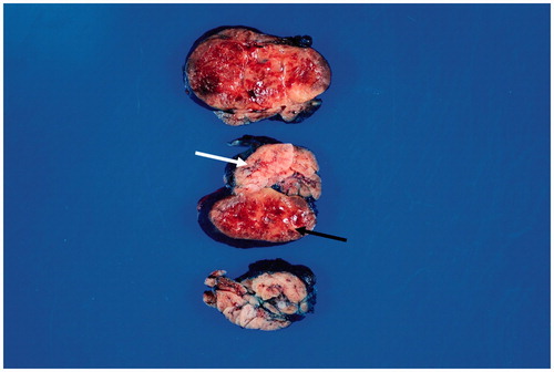 Figure 3. Photograph of the surgical specimen demonstrating tumor and adjacent normal salivary gland (white arrow). The well-demarcated, encapsulated tumor contains both yellow-tan adipose tissue and dark red oncocytic components (dark arrow).