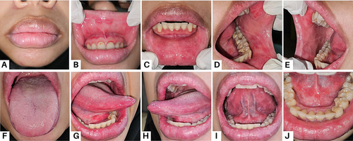 Figure 2 Improvement of the oral lesion on the twelfth day: Lips (A); Upper labial mucosa (B); Lower labial mucosa (C); Left buccal mucosa (D); Right buccal mucosa (E); Tongue dorsum (F); Right lateral tongue (G); Left lateral tongue (H); Tongue ventral (I); and Floor of the mouth (J).