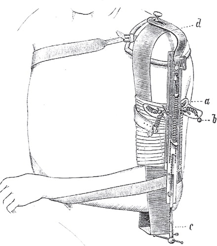 Figure 16. Hennequin’s plaster splint. Reprinted from Stimson (1887)102.