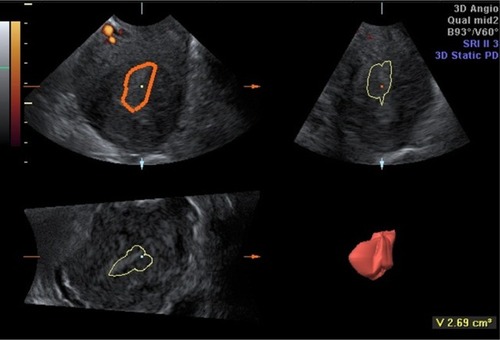 Figure 2 Virtual organ computer-aided analysis of the endometrium.
