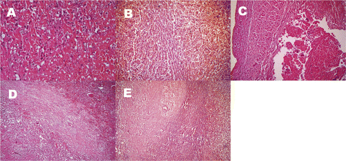 Figure 3. Microscope display of RFA regions: (A) Bleeding and coagulative necrosis of tissue in the RFA region, loose cytoplasm and obvious swelling of surrounding liver cells, and obvious hyperaemia in the hepatic sinusoid were microscopically observed (HE × 200). (B) Some samples of Group II treatment regions showed hepatic cord residue, which indicated incomplete necrosis (HE × 100). (C) In cases where the electrode was 2–5 mm from the vessel wall, endothelial cell morphology was normal and there was no obvious damage to the vessel wall after RFA (HE × 100). (D) Two weeks after RFA, necrotic foci were gradually encapsulated by fibrous tissue in the necrotic region (HE × 100). (E) Four weeks after RFA, collagen hyperplasia, fibrosis, and glassy degeneration with some hepatocyte fatty degeneration are present in the necrosis region (HE × 100).