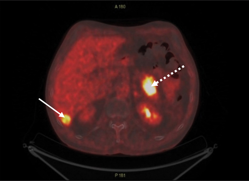 Figure 2. PET/CT revealed increased FDG uptake in liver (arrow) and pancreas (dotted arrow).