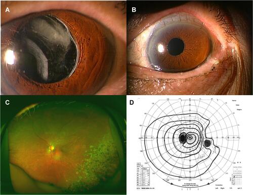 Figure 3 Case 3 was a 77-year-old woman. (A) A nasally dislocated in-the-bag IOL can be seen in the left eye at presentation. (B) Scleral-sutured posterior chamber-IOL was stable at 1.5 years after the surgery. (C) Temporo-inferior peripheral and macular multifocal chorioretinal atrophy at 1 years after surgery. (D) Nasally constricted visual field by Goldmann perimetry at same time.