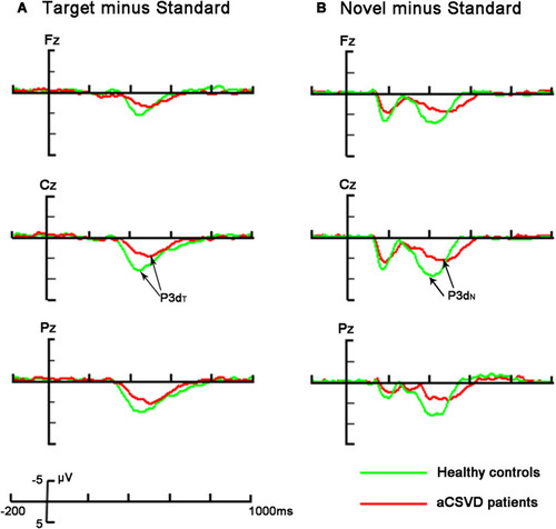 Figure 5 The above description and analysis were the averaged difference waveforms between the two groups (red line represents aCSVD patients and green line represents healthy controls). The electrode position: Fz, Cz, Pz. (A) Target minus standard difference ERPs (P3dT); (B) novel minus standard difference ERPs (P3dN).