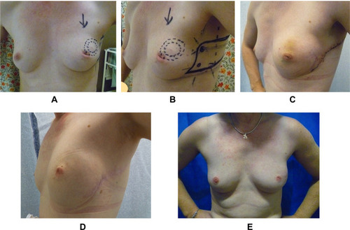 Figure 6 Pre-op and post-op photographs of PBR with lateral CWPF in a slim patient with very small breasts. 42-year old with 20 mm cancer in the upper outer quadrant of left breast with an “A” cup. (A) Pre-operative photograph. (B) Pre-op marking for CWPF. (C) 2 weeks after surgery. (D) 1 year after treatment. (E) 3 years after radiotherapy on right side. Patient had chemotherapy after surgery.