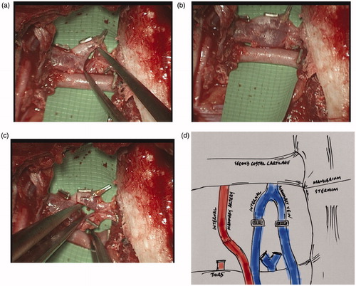 Figure 1. (a–d) Intraoperative photographs and graphic illustration of the left 2nd intercostal space demonstrating the “venous ring” of the internal mammary vein, medial to the artery.