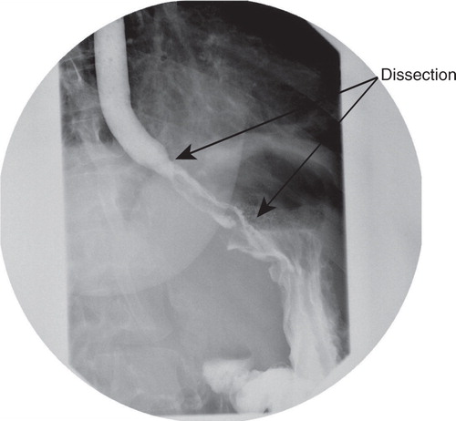 Fig. 3 Repeat barium swallow showing esophageal intramural dissection and a parallel channel formation with no evidence of perforation.