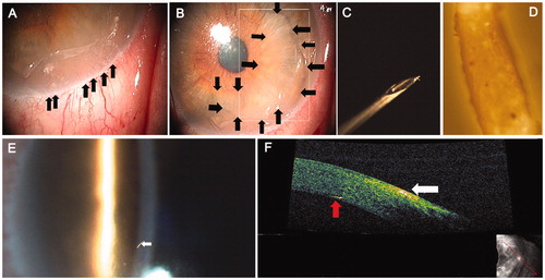 FIGURE 1.  The arrows show multiple embedded hairs in the cornea causing an acute toxic reaction and an epithelial defect (A). The white square shows a bubble-like anterior chamber reaction (B). The setae on a 30-gauge needle (C). 40× magnification of the setae under a microscope (D). Retained intracorneal seta tangential to the endothelial layer with surrounding congestion (E). AC-OCT imaging of the deep seta tangential to the endothelial layer (F).