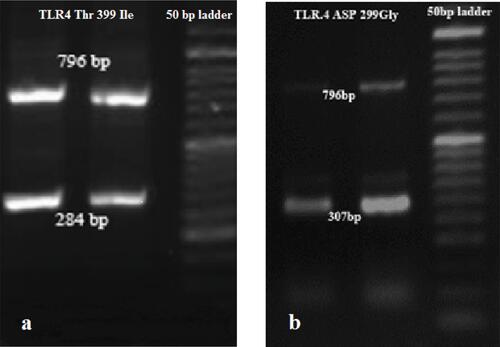 Figure 1 SSP-PCR analysis of the (A) 1196C>T (284 bp) and (B) 896A>G (307 bp) variants in the T2DM patients. This person was heterozygous for both TLR4: 896A>G and 1196C>T.Abbreviations: SSP-PCR, sequence-specific primer PCR; T2DM, Type 2 diabetes mellitus.