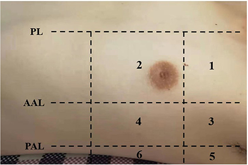 Figure 1 Division of the hemithorax into 6 segments for lung ultrasound examination.