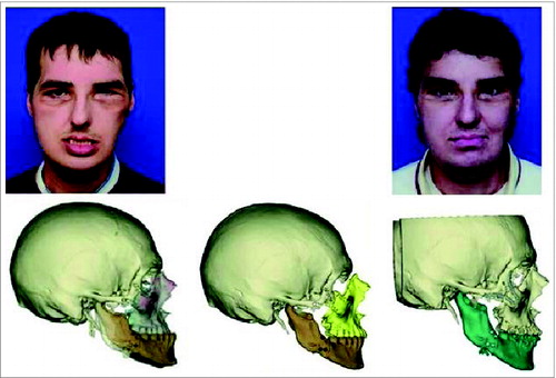 Figure 1. (top left) The patient relapsed into class 3 malocclusion after transplant. (bottom left) Overlay of relapsed occlusion over the original digital 3D image of the post-transplant skeleton. (bottom middle) Digital plan to correct the malocclusion via midface advancement. (top/bottom right) 11-months following initial revisions (and 8-months following second revision) with a digital 3D skeletal image.