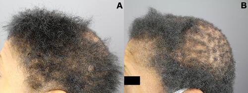 Figure 5 Left parietal area and vertex of patient 3 Images of the left parietal area and vertex of a patient diagnosed with central centrifugal cicatricial alopecia obtained before (A) and after (B) 5 months of treatment with topical Gashee (applied once daily) and two sessions of platelet-rich plasma scalp injections are shown.