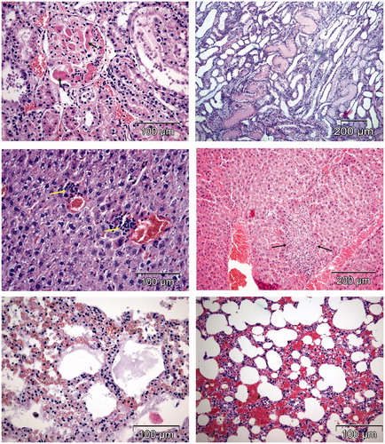 Figure 2. Organ toxicity induced by free DOX (HE stain). Upper micrographs show interstitial hemorrhage in the kidney (left) and fibrin amid deposits (right). Middle micrographs show areas of focal necrosis in the liver. Lower micrographs show pulmonary stasis (left) and hemorrhage (right).