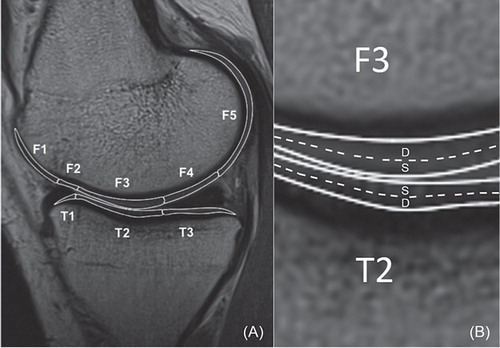Figure 1. A. For sub-compartmental analysis, the cartilage of femur and tibia is divided into sub-compartments with regard to the anterior and posterior horns of the meniscus. The femoral condyle has 5 sub-compartments (F1, F2, F3, F4, and F5) and the tibial plateau has 3 sub-compartments (T1, T2, and T3). B. The articular cartilage is divided into the superficial zone and the deep zone. S: superficial zone; D: deep zone.