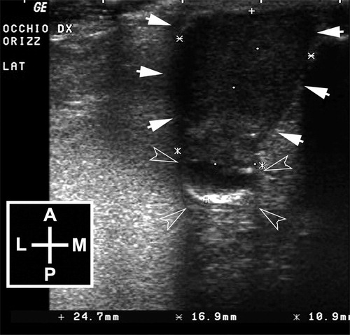 Figure 1. Horizontal ultrasonographic scan of the right eye. The eye shows a “hourglass” shape with a larger echoic anterior lesion (arrows) that continues in a posterior rounded mixed-echoic portion, attributable to the vitreous chamber and the fundus (empty arrow heads). Legend: A = anterior; P = posterior; L = lateral; M = medial.