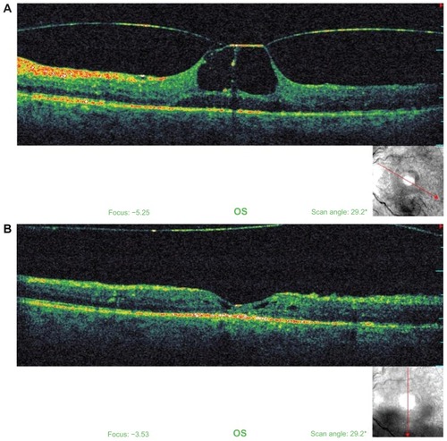 Figure 3 Optical coherence tomography images of the left eye revealing (A) a partially separated posterior vitreous membrane pulling up the fovea and (B) a complete detachment of the posterior hyaloid with release of the vitreomacular traction.