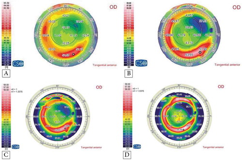Figure 4. Corneal topography of a 17-year-old female patient with KC: (A) preoperatively; (B) at the 6th follow-up month postoperatively; (C) at the 12th follow-up month postoperatively; and (D) at the 18th follow-up month postoperatively.