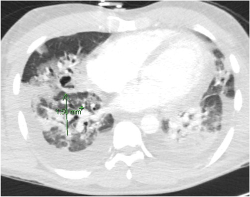 Figure 3. CT chest showing multifocal pneumonia and cavitary lesion.