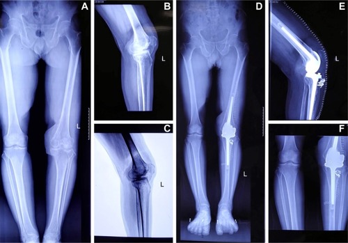 Figure 2 (A) The full length plain of lower extremity; (B) the lateral plain of the left knee; (C) the negative plain X-ray of the left knee. (A–C) Severe degenerative arthritis of the left knee with a low patella and bony fusion of femoral condyle. At 5 months of follow-up the radiographs show, (D) the full length plain of lower extremity; (E) the lateral plain of the left knee; (F) the positive film of the left knee. All the film of left knee revealed the prosthesis was well-fixed without loosening.