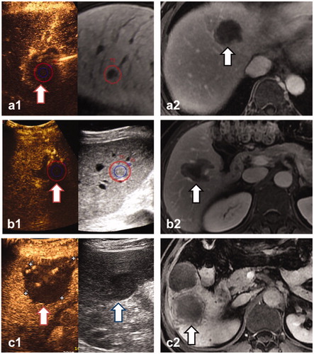 Figure 2. Three lesions were evaluated by CT/MR-CEUS FI (a), 3DUS-CEUS FI (b) and CEUS (c) respectively, and met the requirement of complete ablation. a1, b1: The real-time US is shown at left, the pre-ablation CEMR(a1) and 3DUS(b1) images are shown at right, and the margin of lesion (blue circle) plus a 5-mm AM (red circle) were outlined. The non-perfusion area had entirely covered the lesion and 5-mmAM (red arrow), showing that the lesions were ablated completely and sufficient AM were obtained. c1: The index lesion is shown at right (blue arrow). After ablation, the non-perfusion area covered the whole lesion (red circle), showing complete ablation. a2, b2, c2: CEMR one month after ablation demonstrated the technical efficacy of the ablation (black arrow).