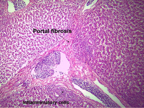 Figure 3. Liver of AF group of 42-day-old broiler chickens showing portal inflammatory cell infiltration and severe portal fibrosis extended between portal areas (H&E × 250.)