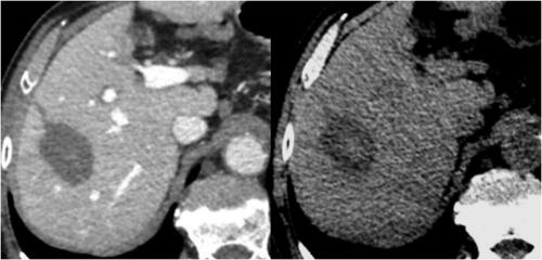 Figure 4. CT images one month after the treatment. Left: the overall ablated zone is identified as the hypo-attenuating area in contrast-enhanced scans. Right: the charred zone is identified as the central zone of hyper-attenuation within the broader hypodense area in unenhanced scans.