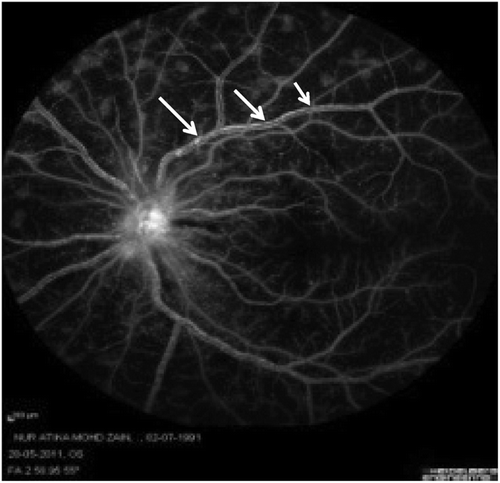 FIGURE 2  Fundus fluorescein angiography showing diffuse and extensive areas of capillary nonperfusion.