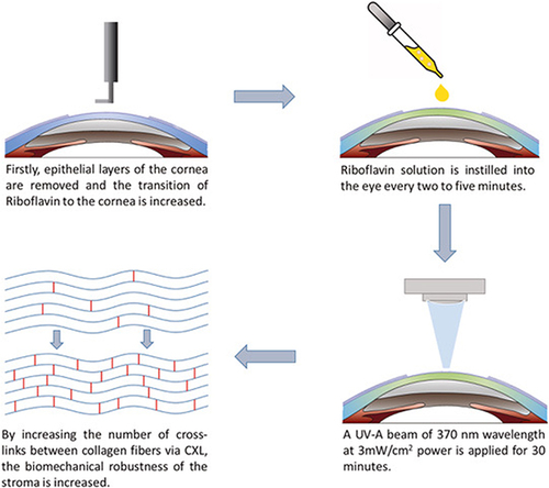 Figure 2 Schematic depiction of the Dresden protocol: removal of corneal epithelium, instillation of riboflavin solution, and application of a UV-A beam of 370 nm wavelength.