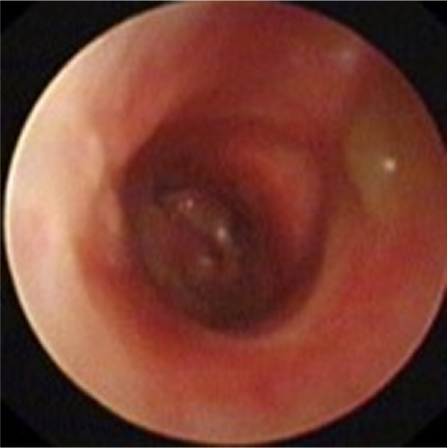 Figure 2 Flexible bronchoscopy showed obstructive stenosis of the trachea.