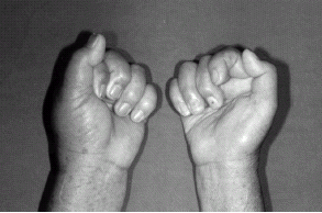 Figure 3. After 18 months, left hand was normal with complete flexion and right hand can extend partially.