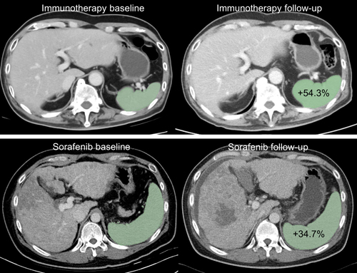 Figure 2 CT-based SV measurement. Upper panel displays the CT scans of a 66-year-old man who underwent therapy with atezolizumab, bevacizumab, and tocilizumab. His SV increased by approximately 54.3%, from 85 cm3 at baseline to 132 cm3 at his 41-day follow-up CT scan. His condition remained stable, and he experienced a DCB, with PFS of 13.8 months. Lower panel displays the CT scans of a 39-year-old man with advanced HCC treated with sorafenib. His SV increased by approximately 34.7%, from 656 cm3 at baseline to 884 cm3 at his 42-day follow-up CT scan. Despite treatment, his condition worsened, and he exhibited PFS of 1.4 months.