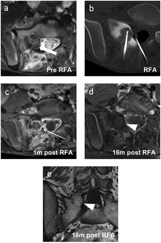 Figure 4. Images of a 10-year-old male with a successfully treated osteoblastoma of the right sacrum. (a) Axial short tau inversion recovery image taken before RFA showing a hyperintense nidus (thick arrow) with extensive perifocal edema. (b) Axial reformation of the CT scan taken during the RFA procedure showing the RFA needle tip in the nidus and an epidural needle for thermal protection. (c, d) Follow-up axial T1-weighted fat-saturated contrast-enhanced images taken at 1 and 16 months post-RFA. (c) A typical post-RFA pattern of a target-like appearance (thin arrow) is seen after 1 month. (e) Disappearance of the peripheral nidus enhancement (arrowhead) and perifocal edema after 16 months. (f) Follow-up coronal T1-weighted images of the same MRI as in (e) taken 16 months after RFA showing fatty conversion of the nidus (arrowhead). RFA: radiofrequency ablation.
