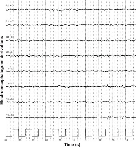 Figure 4 Electroencephalogram showing diffusely deregulated cerebral electrical activity together with ubiquitous fast paroxysms, prevalent in the left temporal area.