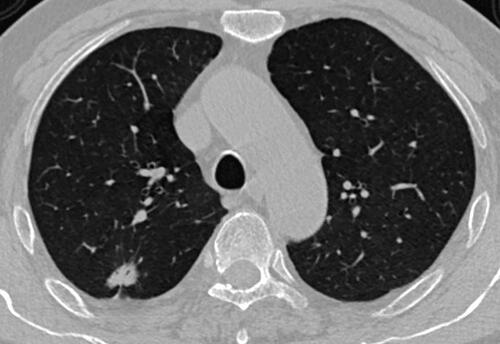 Figure 2 Malignant PSN on CT image. Axial CT image in a 76-year-old male shows a lobulated, heterogeneous, and well-defined PSN with air bronchogram, spiculation, and pleural indentation located in the right upper lobe. It was confirmed as invasive adenocarcinoma after surgical resection.