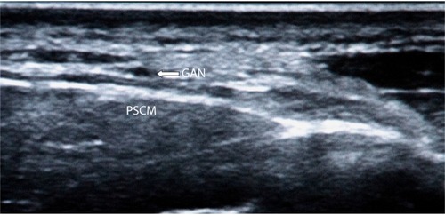 Figure 1 Ultrasound-guided transverse view of the GAN.