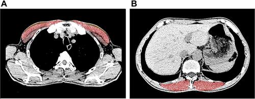Figure 3 Sample computed tomography (CT) scans used to determine pectoralis muscle, erector spinae muscle. (A) Pectoralis major muscle shaded in red, pectoralis minor muscle shaded in brown. (B) Erector spinae muscle shaded in red.