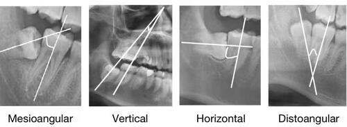 Figure 4 Winter classification. Mesioangular: 11° to 79°; Vertical: −10° to 10°; Horizontal: 80° to 100°; Distoangular: −11° to−79°.