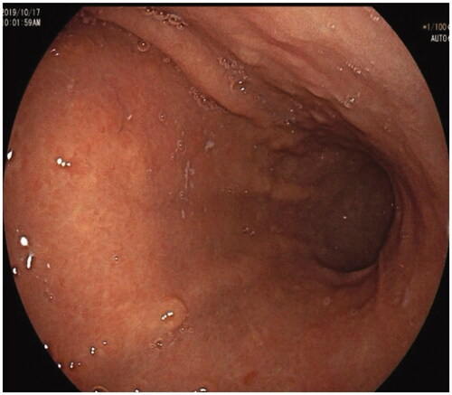 Figure 2. Moderate atrophic gastritis, thinning mucosa, flattened rugal folds and submucosal micro-vessel in the corpus.