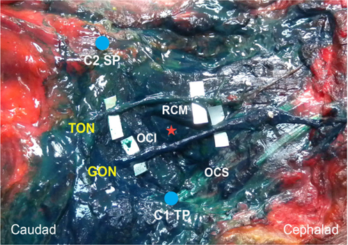 Figure 3 Suboccipital region after GON block using 5 mL of dye solution.