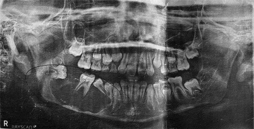 Figure 1. Panoramic radiograph demonstrating an expansile, well-circumscribed, unilocular radiolucency of the right posterior body and angle regions of the mandible causing displacement of the second premolar and second molar.