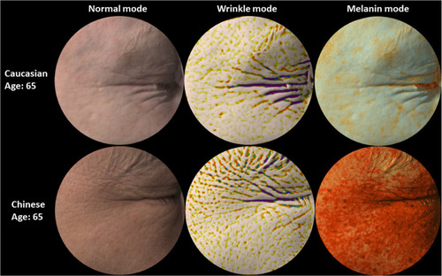 Figure 2 Representative images of Caucasian and Chinese skin. Representative images of 65 years old Caucasian and Chinese facial skin (Crow's Feet) captured with the Antera 3D camera. Starting from the left: normal mode showing images as perceived by the naked eye, wrinkle mode where depressions are highlighted with dark colours (the darker the deeper the wrinkle) and melanin mode where higher concentrations of melanin are rendered in darker orange color. Deeper wrinkles, yet less pigment spots, are observed in Caucasian skin compared to Chinese skin.