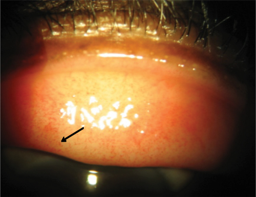 Figure 1 Slit-lamp photography of superior palpebral conjunctiva with petechial hemorrhages (black arrow) in a patient with adenoviral keratoconjunctivitis.