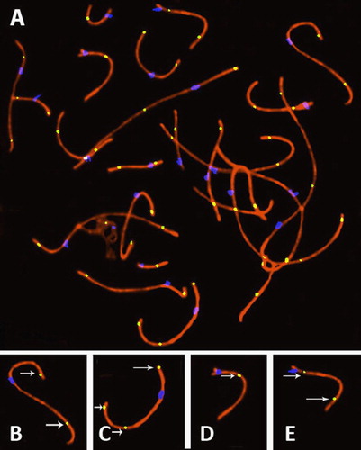 Figure 1.  Human pachytene spermatocyte. (A) Synaptonemal complex is labeled in red, centromeres in blue, and sites of recombination (MLH1) foci in yellow. (B–E) Show individual synaptonemal complexes taken from the pachytene spermatocyte (A). These illustrate the preferential localization of recombination (indicated by arrows) and how the presence of two recombination foci results in positive interference. B and C show the presence of recombination foci on both the p-arm and the q-arm of submetacentric chromosomes, whereas acrocentric chromosomes shown in D and E only possess recombination foci on the q-arm.