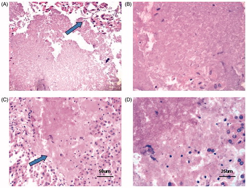 Figure 5. Histological changes after HIFU exposure. (A & B) Continuous-wave HIFU exposure (A, ×200; B, ×400). (C & D) Pulsed HIFU exposure (C, ×200; D, ×400). An abrupt boundary was observed between the treated region and the normal tissue (×200) (Arrowhead). Treated tissues showed pyknotic nuclei, karyolytic nuclei, or complete cell debris.